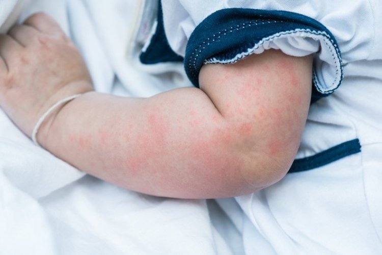 Da bé bị mẩn đỏ vì dị ứng vải quần áo